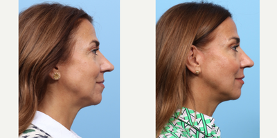 55-64 year old woman treated with Nonsurgical Facelift, Botox - Dr. Wise performed a liquid facelift on this 58-year-old patient using a combination of Botox and dermal fillers. The fillers were strategically injected into the cheeks to contour and subtly lift, diminish under-eye hollows, and add volume. Additionally, Botox was also injected to smooth overall wrinkled skin.