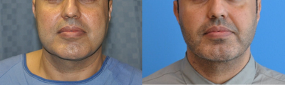 Buccal Fat Removal - Buccal Fat Removal