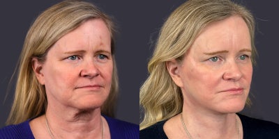 55-64 year old woman treated with ActiveFX, Brow Lift, Facelift, Laser Resurfacing, Lower Facelift, Neck Lift, SMAS Facelift - 56 year old who presented for facial rejuvenation. She is 5'5 and 158 pounds. She had a brow lift, lower face and neck lift, as well as central face CO2 laser skin resurfacing.