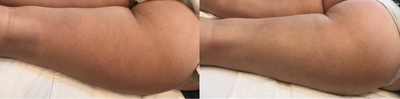 25-34 year old woman treated with Body Wrap - Skin Toning Treatment - Thigh, Before and After