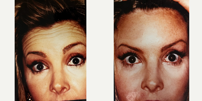 Patient treated with Botox - Patient treated with Botox