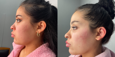 18-24 year old woman treated with Voluma - Patient treated with voluma in mid and lateral cheeks