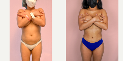18-24 year old woman treated with Brazilian Butt Lift, Liposuction - This lovely patient underwent a 360 Liposuction with Brazilian Butt Lift. She had 1400cc's of fat grafted to her buttocks and hips - delivering an hourglass shape with unparalleled curves that are truly desirable.