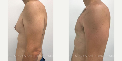 44 year old man treated with Gynecomastia Surgery - 44 year old man treated with Gynecomastia Surgery