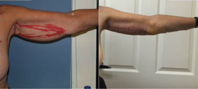 55-64 year old woman treated with Arm Lift - Brachioplasty is made to remove extra skin from the arms.