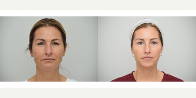 35-44 year old woman treated with GentleLase, Dysport, Revanesse, RHA Collection Fillers - Combination aesthetic treatment (Precise Aesthetic Balance) of Alex Gentelase laser for sun spots and skin photodamage to brighten skin tone and Dysport to glabella to relax tension frown lines, aka 11s, and Versa Hyaluronic Acid Filler in smile lines (nasolabial folds and marionettes) to soften wrinkle lines around the mouth.