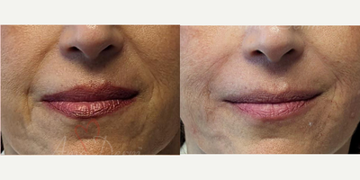 55-64 year old woman treated with Juvederm, Vollure - Treatment of nasolabial folds (laugh lines) and marionette lines with Juvederm, Radiesse, Vollure, Restylane or Bellafill injected with cannula