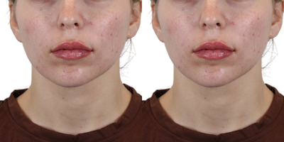 Naturally plump and perfect your lips with Lip Fillers! - our expert injector added volume, shape, and definition to the lips to create a natural-looking plump and hydrated effect. Our team is all about enhancing your natural beauty and achieving symmetry, and balance in every treatment. At AdmireMD Skin Clinic, we take pride in our commitment to helping our patients achieve their desired aesthetic outcomes. Our dedicated team works closely with each individual, understanding their unique goals and concerns. We stay updated with the latest techniques in the field to ensure that we bring our patients the best possible results.