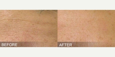 Patient treated with HydraFacial - Before & After, HydraFacialThe indulgent and hydrating HydraFacial is a skin non-invasive, serum based resurfacing procedure that is suitable for all skin types.