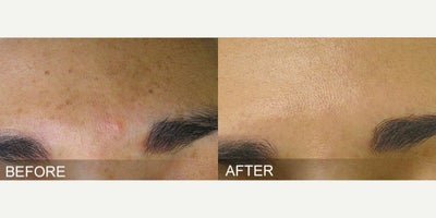 Patient treated with HydraFacial - Before & After, HydraFacialThe indulgent and hydrating HydraFacial is a skin non-invasive, serum based resurfacing procedure that is suitable for all skin types.