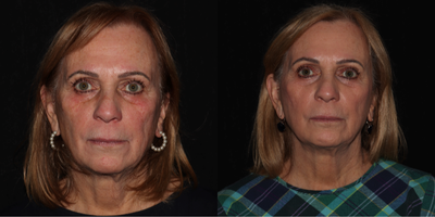 65-74 year old woman treated with Sofwave - This lovely 71 year old client underwent a single session of Sofwave, Full Face and Neck. This is her 3 month result. Although she will see continued improvement for still another 3 months, already there is noticeable change in her skin texture and tightness.