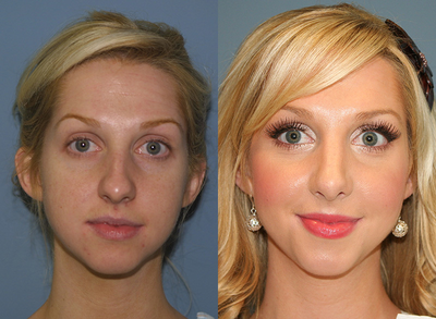 Woman treated with Rhinoplasty - Woman treated with Rhinoplasty
