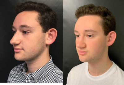 18-24 year old man treated with Rhinoplasty - 18-24 year old man treated with Rhinoplasty with septoplasty