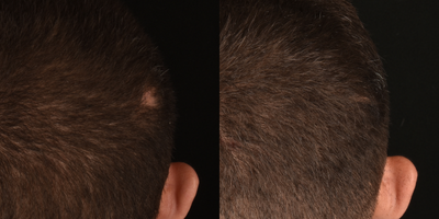25-34 year old man treated with Hair Loss Treatment - Our blood consists of two main components, red blood cells and plasma. The plasma contains white blood cells and platelets that are rich in growth factors. By extracting and isolating these growth factors, specifically the platelet-rich fibrin or #PRF, we can harness the all-natural regenerative properties to stimulate the activity of hair follicles to promote new hair growth. There are no additives to this meaning this all-natural treatment is entirely from ones own body. Anyone experiencing hair loss is essentially a good candidate for PRF treatments, especially those who are experiencing early signs of hair loss.