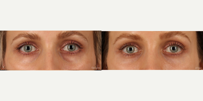Scarless Lower Bleph (Eyelid Lift) with Fat Transfer and CO2 Laser Resurfacing - This beautiful 31-year-old female struggled with lower lid bags that were worsening with age. A transconjunctival (Scarless) lower lid blepharoplasty was performed to reduce the bags. Finesse multi-level fat transfer was performed to create mid-facial and lower lid contours. Fractional CO2 laser resurfacing was performed to tighten and rejuvenate the skin around the eyes.