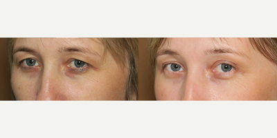Woman treated with Eyelid Surgery - Woman treated with Eyelid Surgery