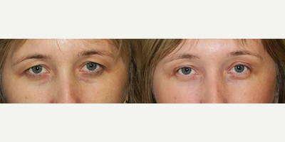 Woman treated with Eyelid Surgery - Woman treated with Eyelid Surgery