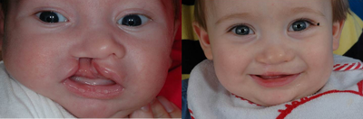 Cleft Lip - Unilateral Cleft Lip Repair