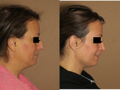 25-34 year old woman treated with Liposuction - Lipo of the Neck and Rhinoplasty