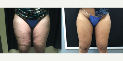 45-54 year old woman treated with Cellfina - Cellfina on the upper legs for dimples
