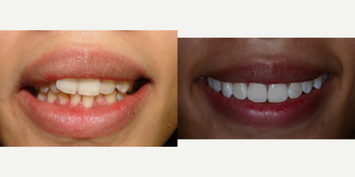 25-34 year old woman treated with Clear Braces - Invisalign case completed with whitening