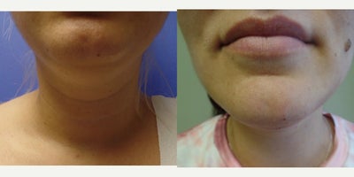 25-34 year old woman treated with FaceTite - Liposuction and FaceTite of jowls neck and chin