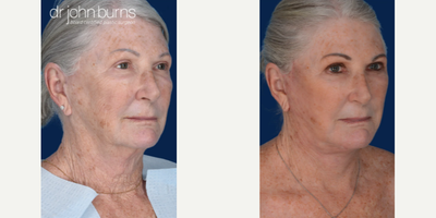 Woman treated with Facelift Revision - Woman treated with Facelift Revision and Neck Lift