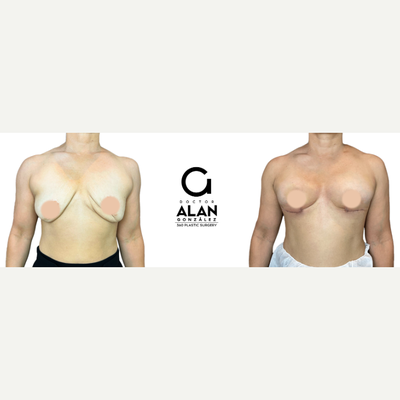 35-44 year old woman treated with Breast Reconstruction - Breast reconstruction in Colombia is a way to improve the results of previous procedures by adding volume, shape, and lift to the breasts using the patients tissue. Dr. Alan repositions tissue to create the new breast shape. This procedure forms a natural-looking and feeling breast mound with results that last a lifetime. In some cases, breast reconstruction alone doesnt provide sufficient volume in the breasts. Patients wishing additional fullness can return for adipose tissue or fat grafting. These procedures work best when performed at least six months after the initial breast construction to achieve the highest survival rate for the fat graft and the lowest risk of complications.
