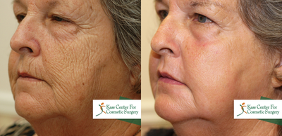 65-74 year old woman treated with Phenol Peel - This very sweet 65 year old woman came to see Dr. Kass. She complained of her fine lines and wrinkles&nbsp;