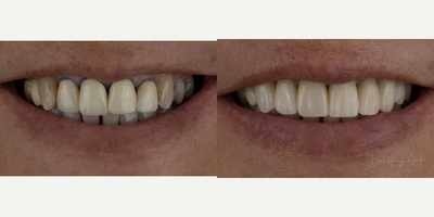 55-64 year old woman treated with Dental Crown, Porcelain Veneers, Smile Makeover - Black triangles, flat papilla and old restorations were some of the concerns for this patient. Smile transformation was completed with the combination of veneers and crowns.