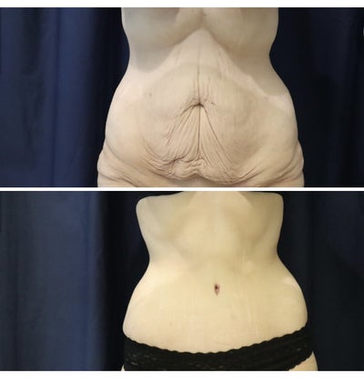 Total Body Lift - Lower Body Lift + Mons Pubis Lift + Thigh Lift + Arm Lift  + Breast Implants & Lift - Dr. Guy Watts