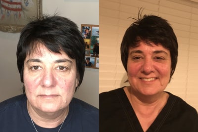 55-64 year old woman treated with Microneedling - 57 year old female 3 days after 1 treatment with Aqua gold micro needling with PRP and Botox
