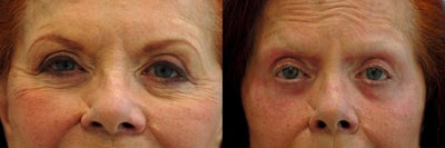 65-74 year old woman treated with Laser Resurfacing to the under eye area - 72 year old female with concern over loose skin and wrinkling under the eyes. She had a previous blepharoplasty and did not want to undergo a second procedure, nor did she have the downtime for a phenol peel. This is after CO2 laser resurfacing, with noted improvement in the quality of the skin as well removal of wrinkles.