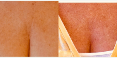 45-54 year old woman treated with Ultherapy - 3 months post Ultherapy chest for fine lines.