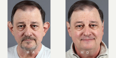 Woman treated with Ear Surgery - Check out the remarkable results of our patients otoplasty journey