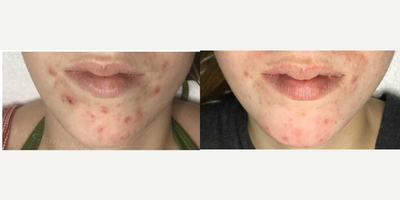 17 or under year old woman treated with Neo Laser - Patient treated with Aerolase Neo