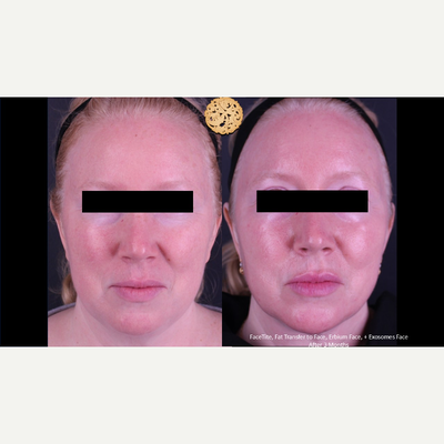 45-54 year old woman treated with FaceTite, Eyelid Surgery - FaceTite, Fat Transfer to Face, Erbium Face, + Exosomes Face After 3 Months