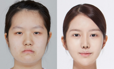 25-34 year old woman treated with V Line Surgery - Smile Double Jaw Surgery + Shaping Facial Contouring