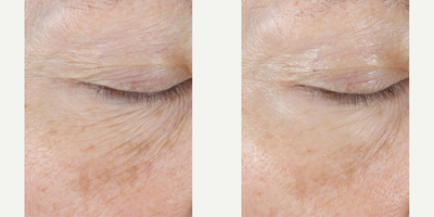 Skinbetter Science - InterFuse Intensive Treatment Cream Eye.Photo provided courtesy of Skinbetter Science.