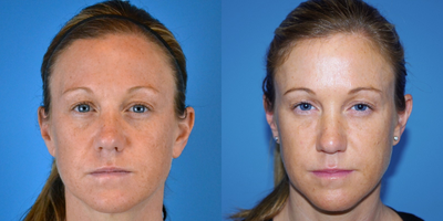 35-44 year old woman treated with ArteFill - 38 year old female received Artefill under eyes