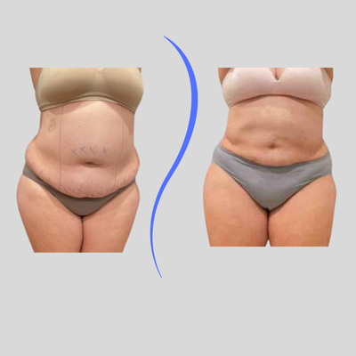 45-54 year old woman treated with Body-Jet Liposuction - Abs and Flank Liposuction with Funsculpting
