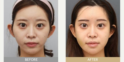 18-24 year old woman treated with Cheekbone Reduction - Facial Contouring 3-Set