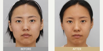 25-34 year old woman treated with Cheekbone Reduction - Facial Contouring - Cheekbone reduction