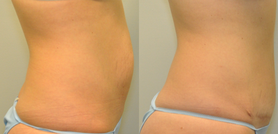 31 year old woman treated with Drainless Tummy Tuck - 31 year old female 9 months following a Drainless Tummy Tuck using a progressive tension technique.