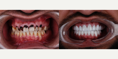 35-44 year old man treated with Dental Implants, Porcelain Veneers, Dental Crown, Tooth Repair - Dental implants and smile design with ceramic veneers, aesthetic result, maintaining functionality