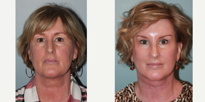 55-64 year old woman treated with Blue Peel - This patient had a LiteLift, Chin augmentation, Temple lift, Blue Peel, and neck lift were performed simultaneouslyon an out patient basis under general anesthesia.After photos were taken 7 months post-op.