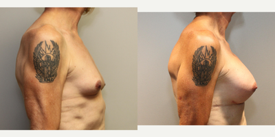45-54 year old woman treated with MTF Breast Augmentation - Patient is a transitioning female who wanted breasts to assist with her transformation. She received Sientra 485 HP implants.
