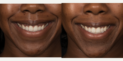 18-24 year old woman treated with Botox - Botox to improve gummy smile
