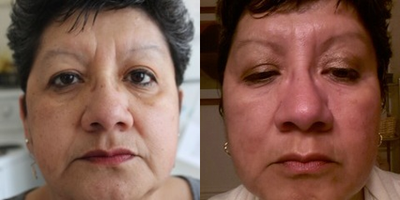 55-64 year old woman treated with Blue Peel - 55-64 year old woman treated with Blue Peel for pigmentation, aging and overall rejuvenation. She was on 6-weeks of Hydroquinone Kit from ZO Medical and 30% TCA Blue Peel was performed. On the post-peel pics, see the changes in her pigmentation (keratosis and lentigo's removed), deeper lines in her glabella, marionette's and nasolabial are improved, fine lines around the eyes and mouth are improved, and skin texture is improved overall. She looks much younger and skin has an overall fresh appearance.