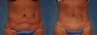 53 year old Female who underwent Tummy Tuck Revision to improve appearance of prior surgery - 53 year old Female who underwent Tummy Tuck Revision to improve appearance of prior surgery.  She did not like the extremely high scar and uneven contour.  A revision tummy tuck was performed to lower the scar and level out the contours.